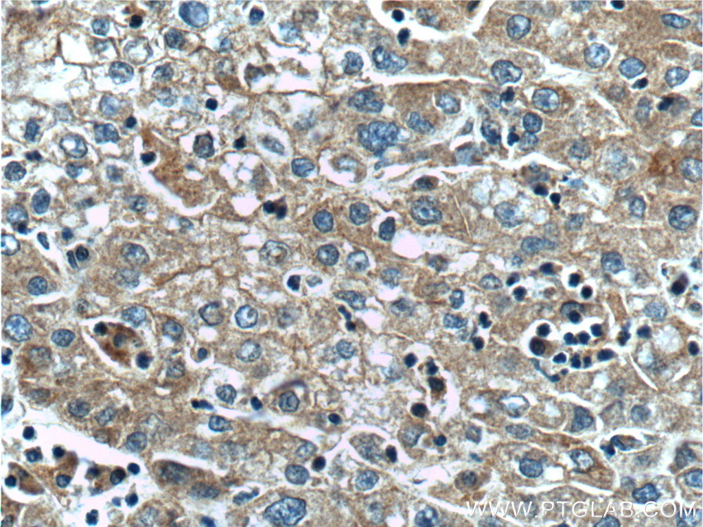 IHC staining of human liver cancer using 66381-1-Ig (same clone as 66381-1-PBS)