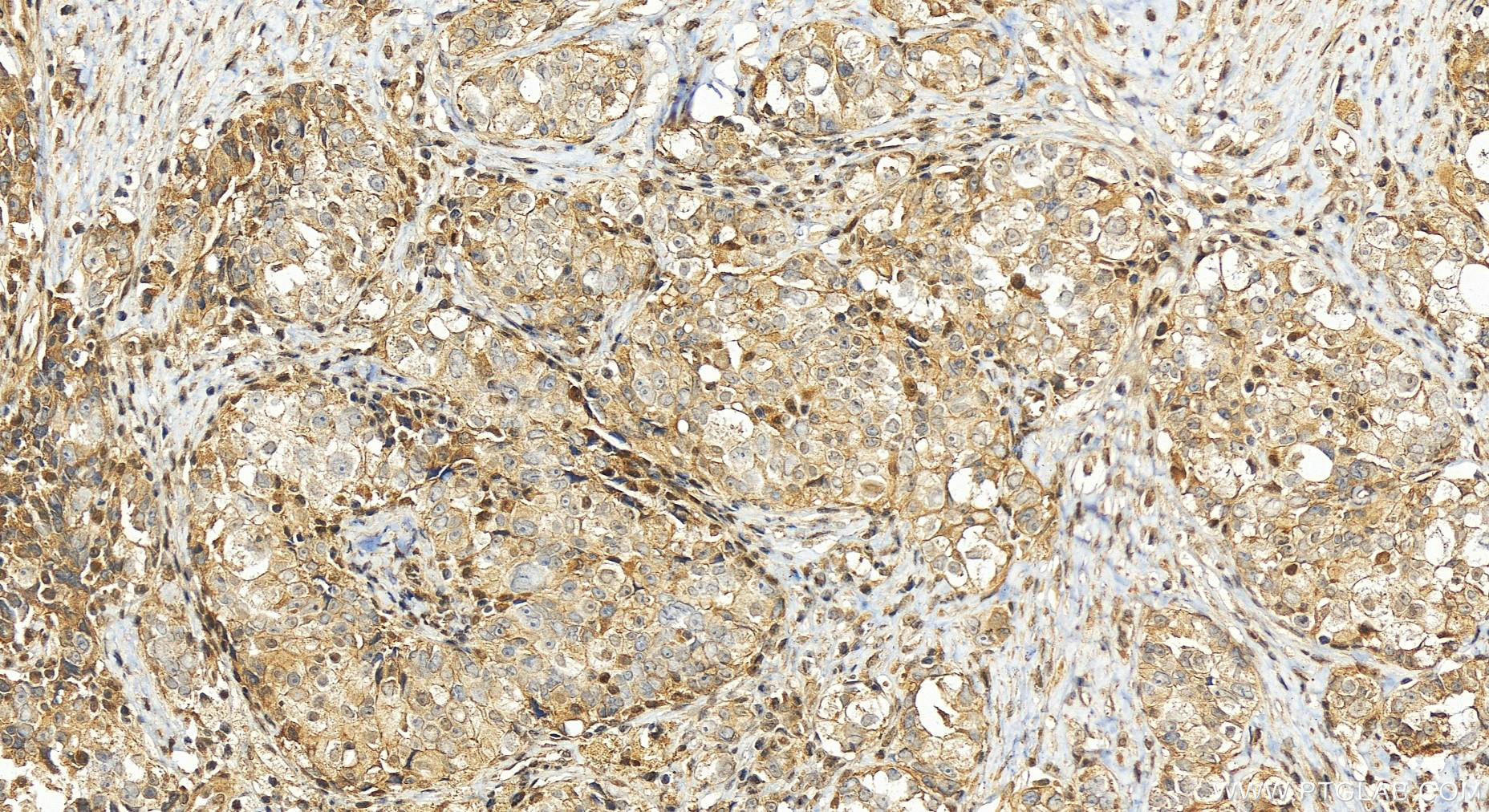 IHC staining of human ovary cancer using 26060-1-AP