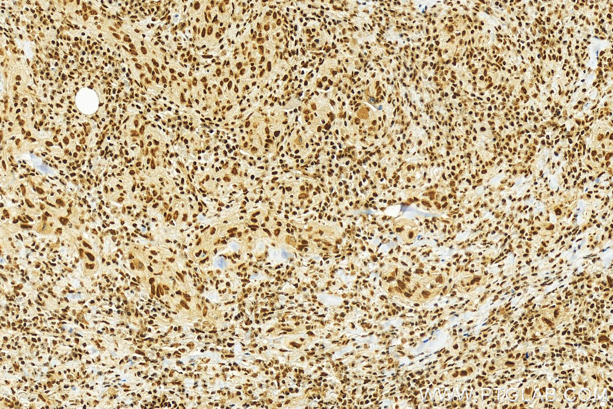 IHC staining of human skin cancer using 17889-1-AP