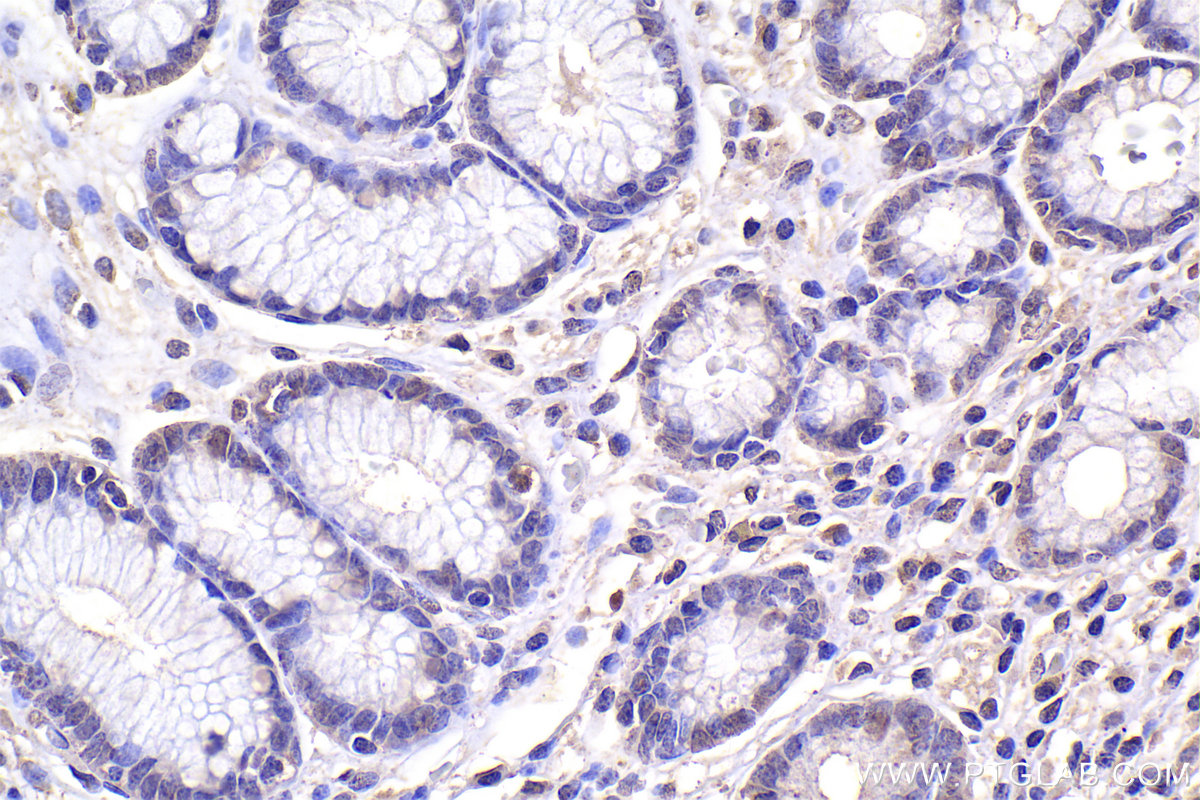 IHC staining of human stomach cancer using 66516-1-Ig