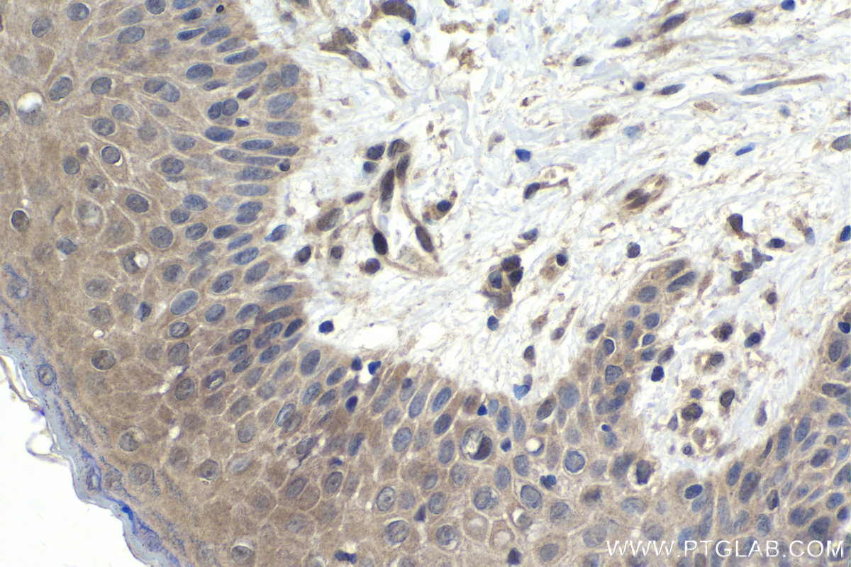 IHC staining of human skin cancer using 10231-1-AP