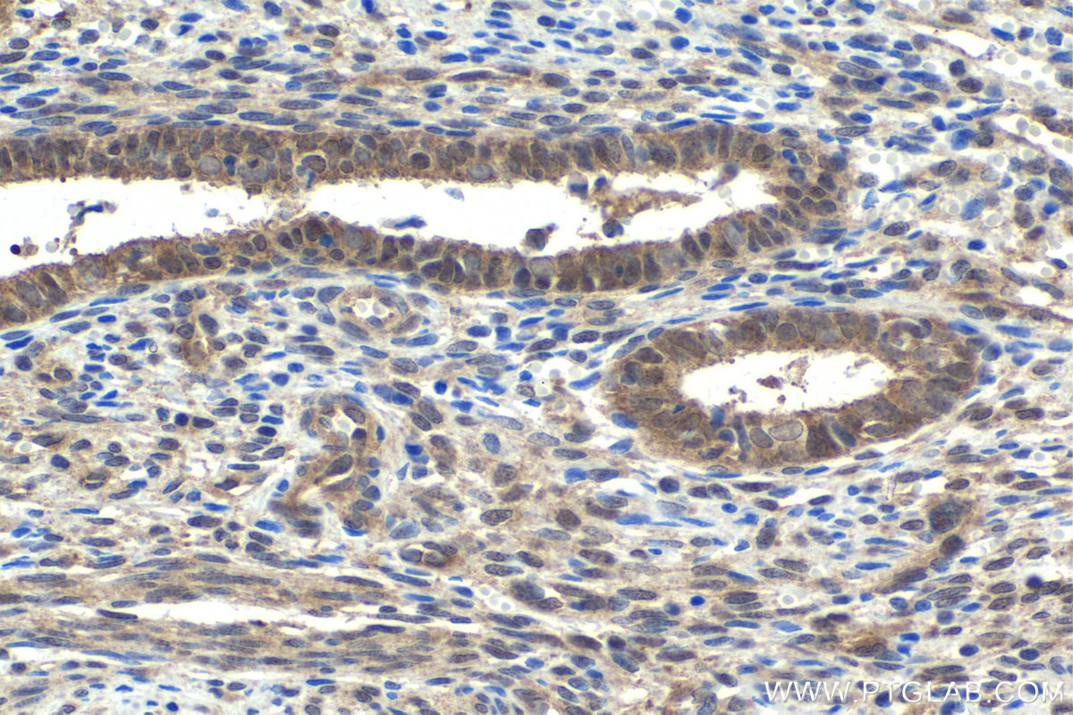 IHC staining of human cervical cancer using 10231-1-AP