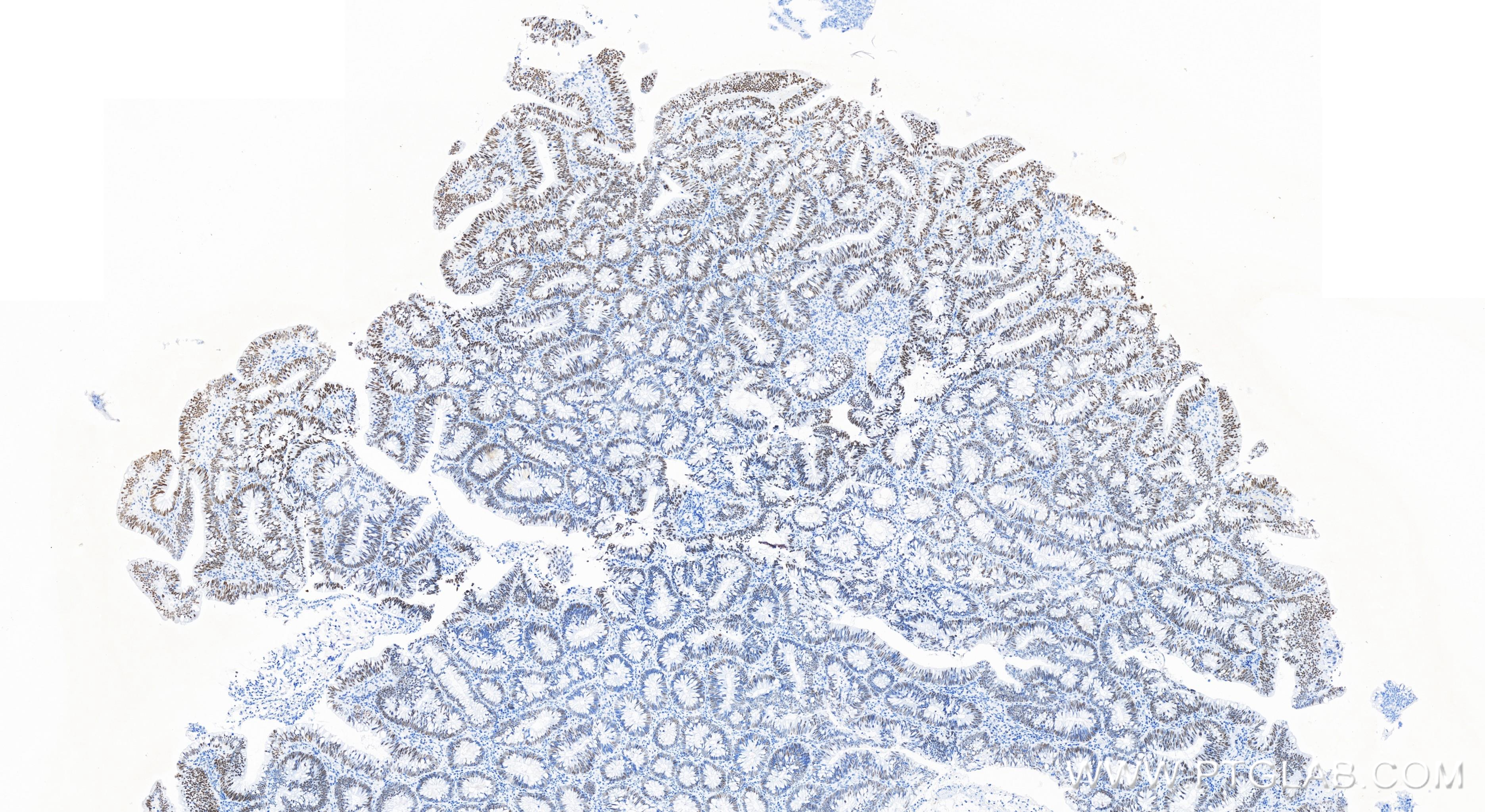 IHC staining of human colon cancer using 83310-7-RR (same clone as 83310-7-PBS)