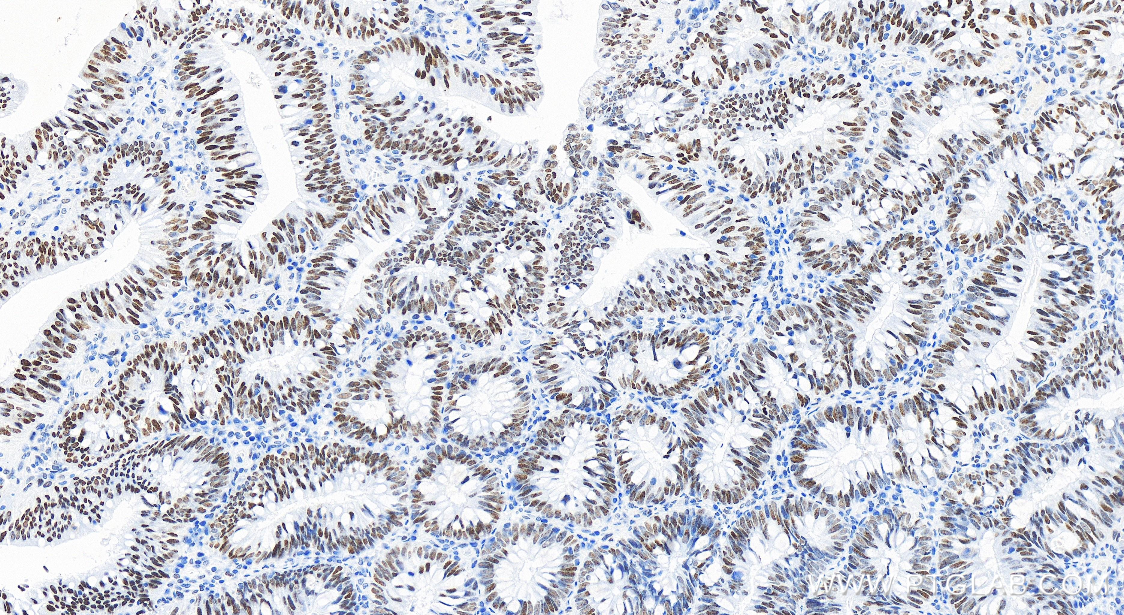 IHC staining of human colon cancer using 83310-7-RR (same clone as 83310-7-PBS)