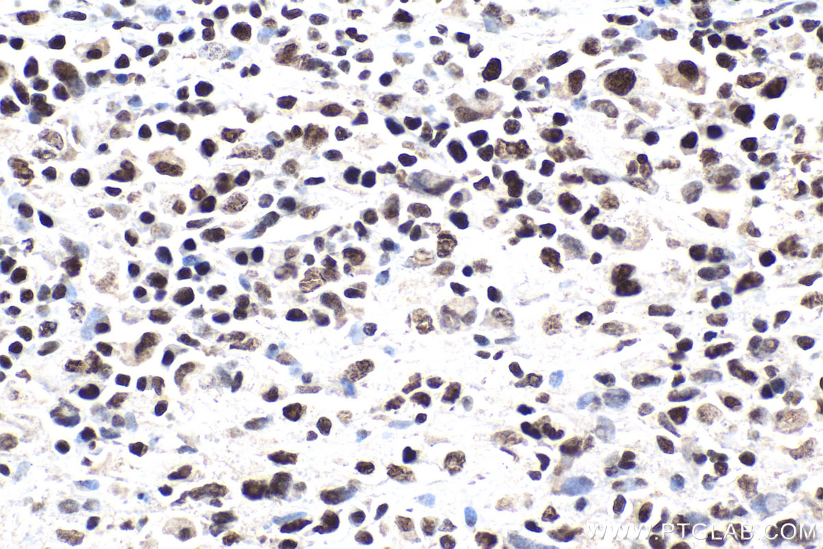 IHC staining of human malignant melanoma using 17722-1-AP