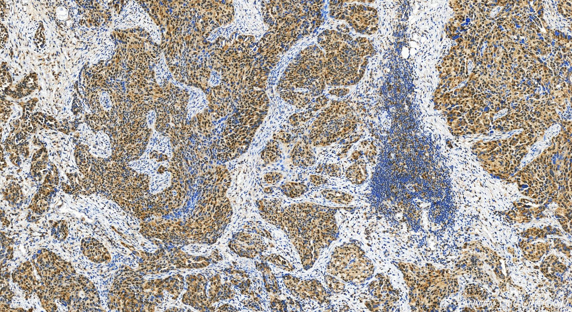 IHC staining of human ovary cancer using 30707-1-AP