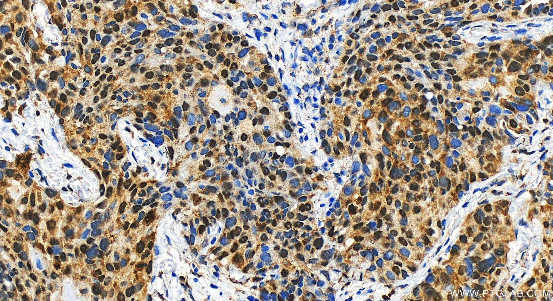 IHC staining of human ovary cancer using 30707-1-AP