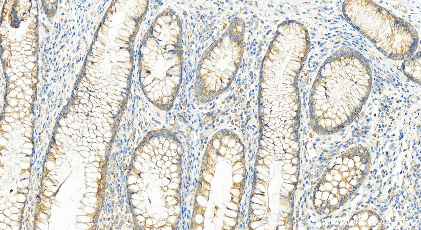 IHC staining of human colon cancer using 25815-1-AP