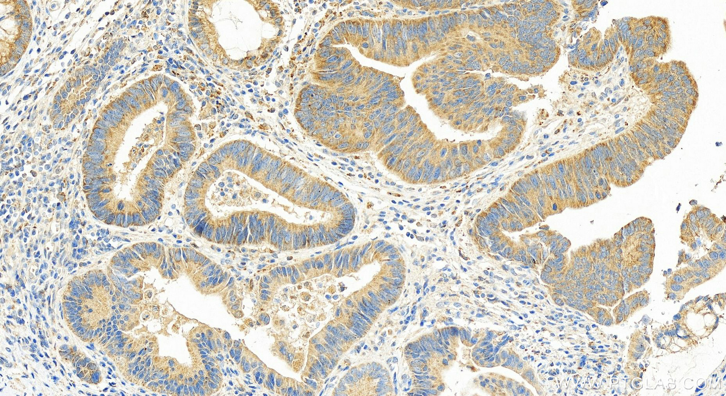 IHC staining of human colon cancer using 25815-1-AP