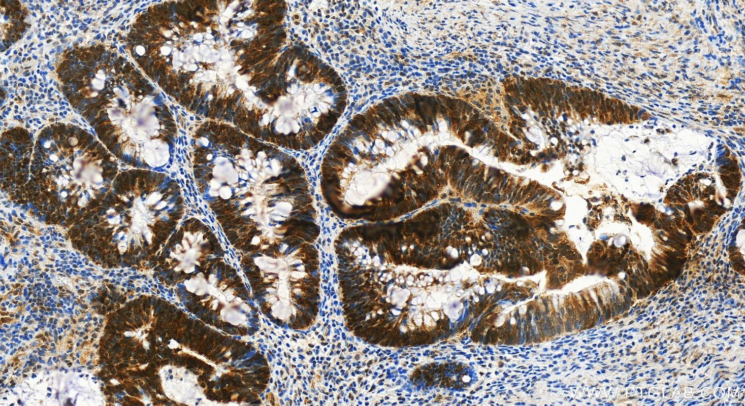 IHC staining of human colon  cancer using 60154-1-Ig