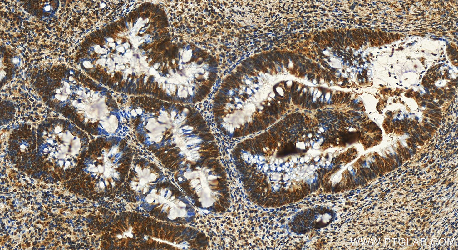 IHC staining of human colon  cancer using 60154-2-Ig (same clone as 60154-2-PBS)