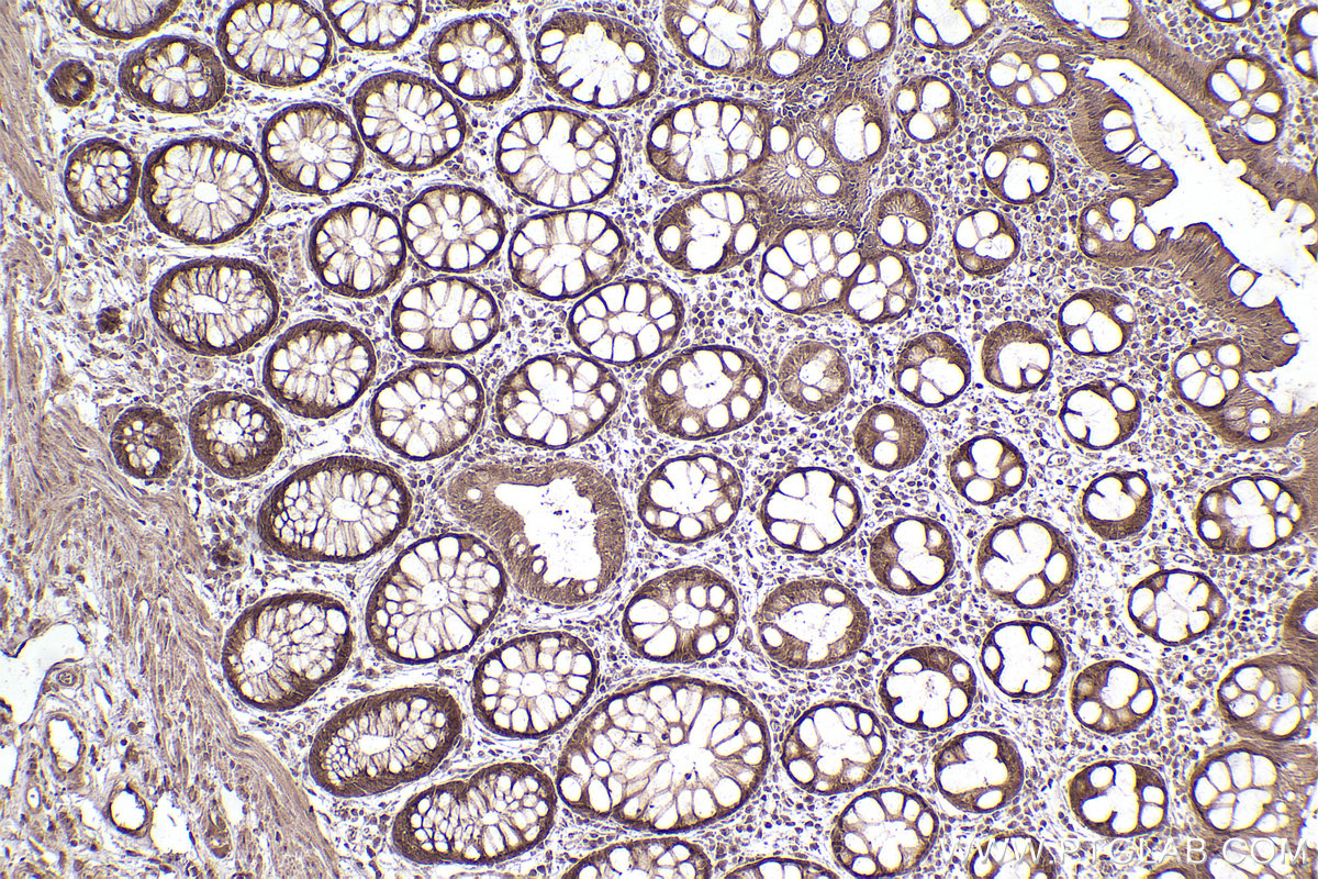 IHC staining of human rectal cancer using 60154-2-Ig