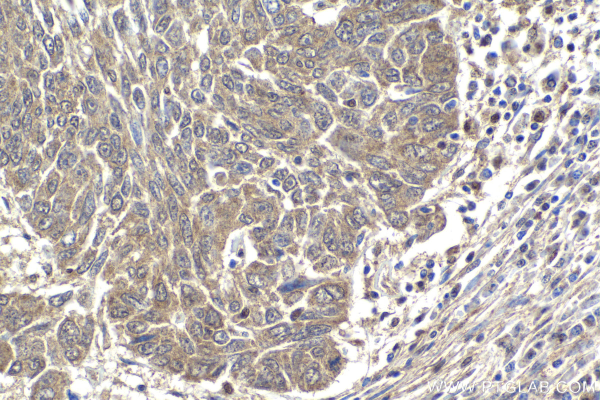 IHC staining of human lung cancer using 18038-1-AP