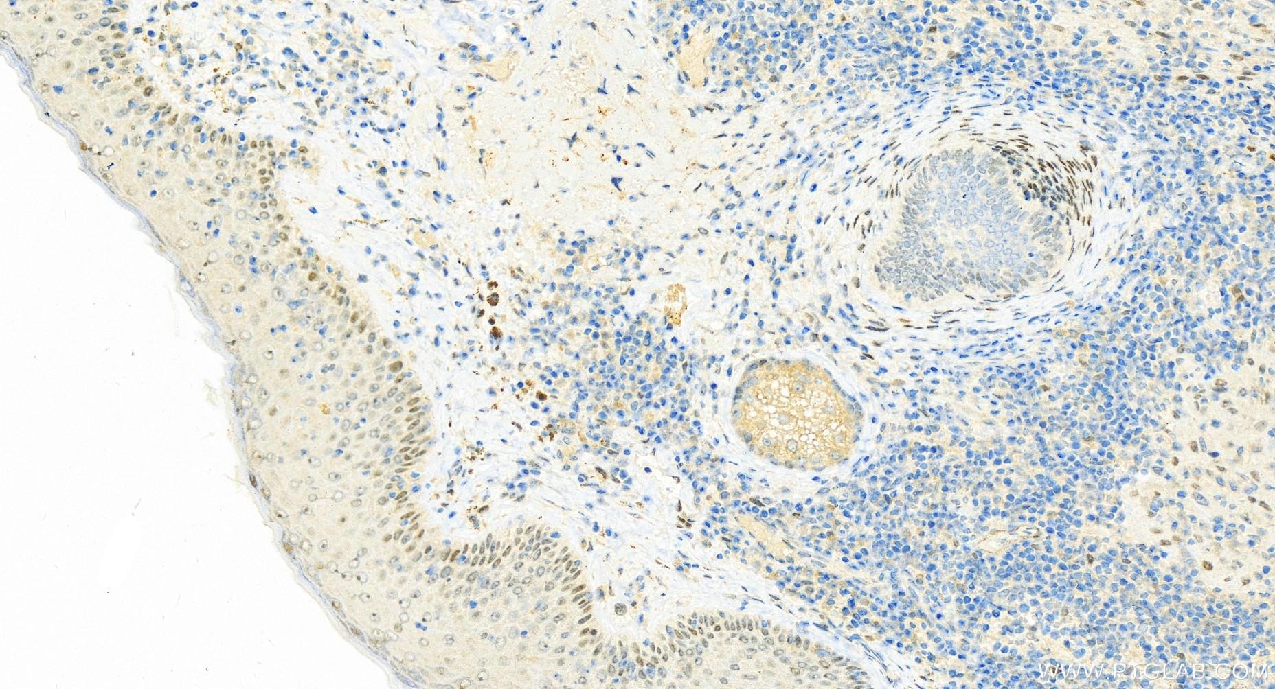 IHC staining of human skin cancer using 12129-1-AP