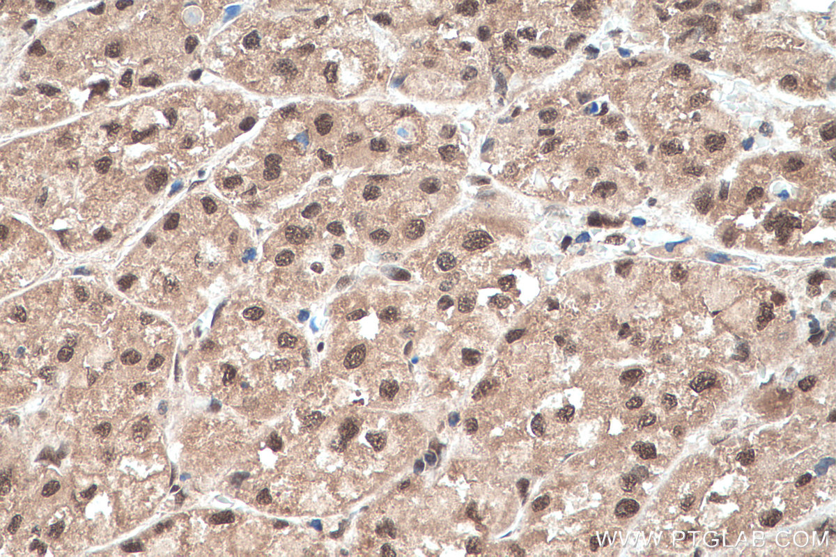 IHC staining of human liver cancer using 10212-1-AP