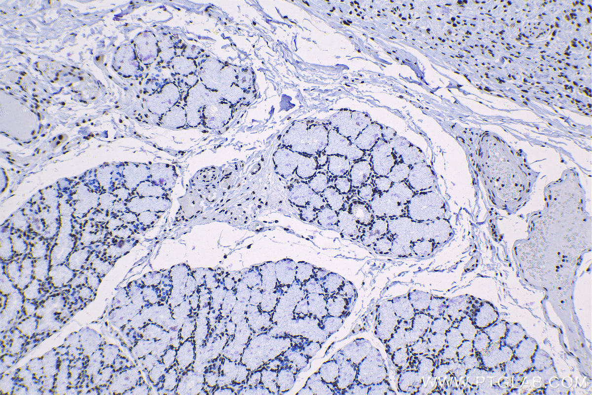 IHC staining of human stomach cancer using 17368-1-AP