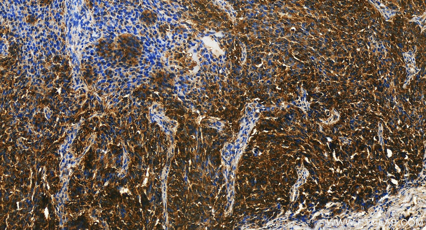 IHC staining of human ovary cancer using 16799-1-AP