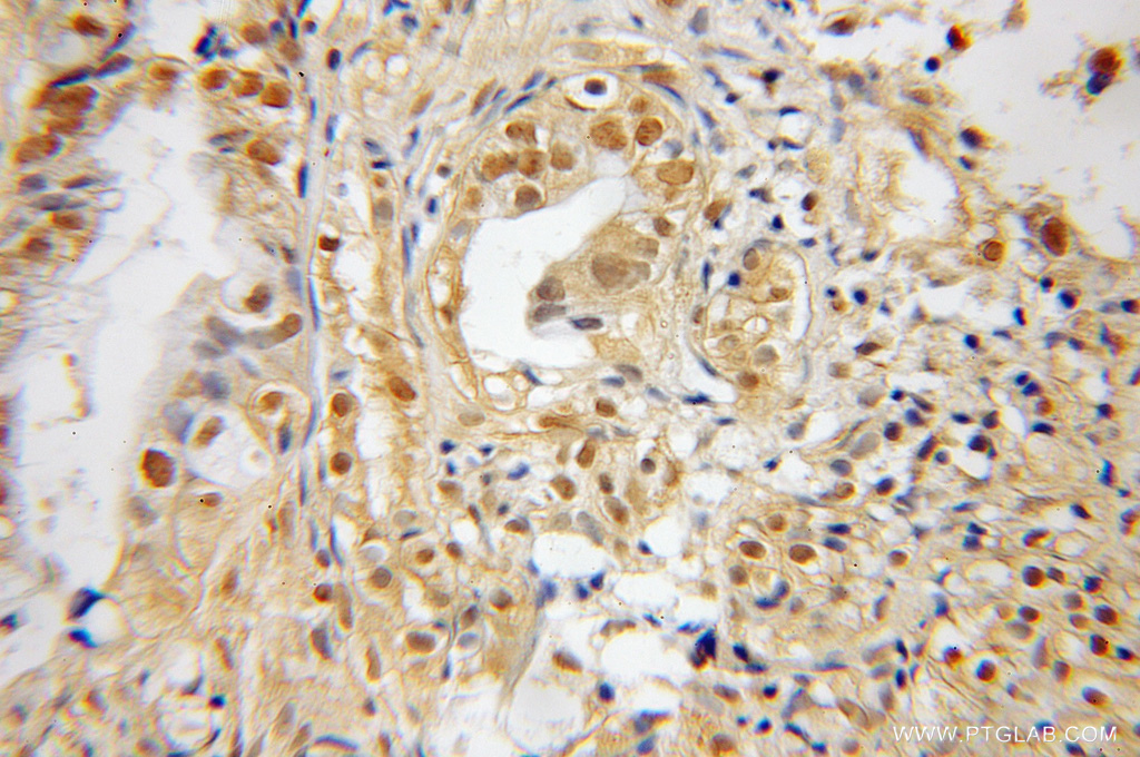 IHC staining of human pancreas cancer using 12269-1-AP