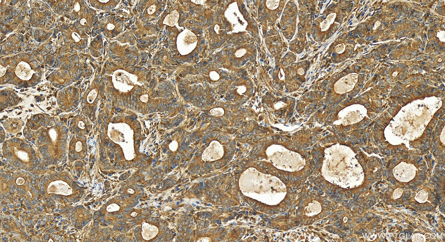 IHC staining of human stomach cancer using 15721-1-AP