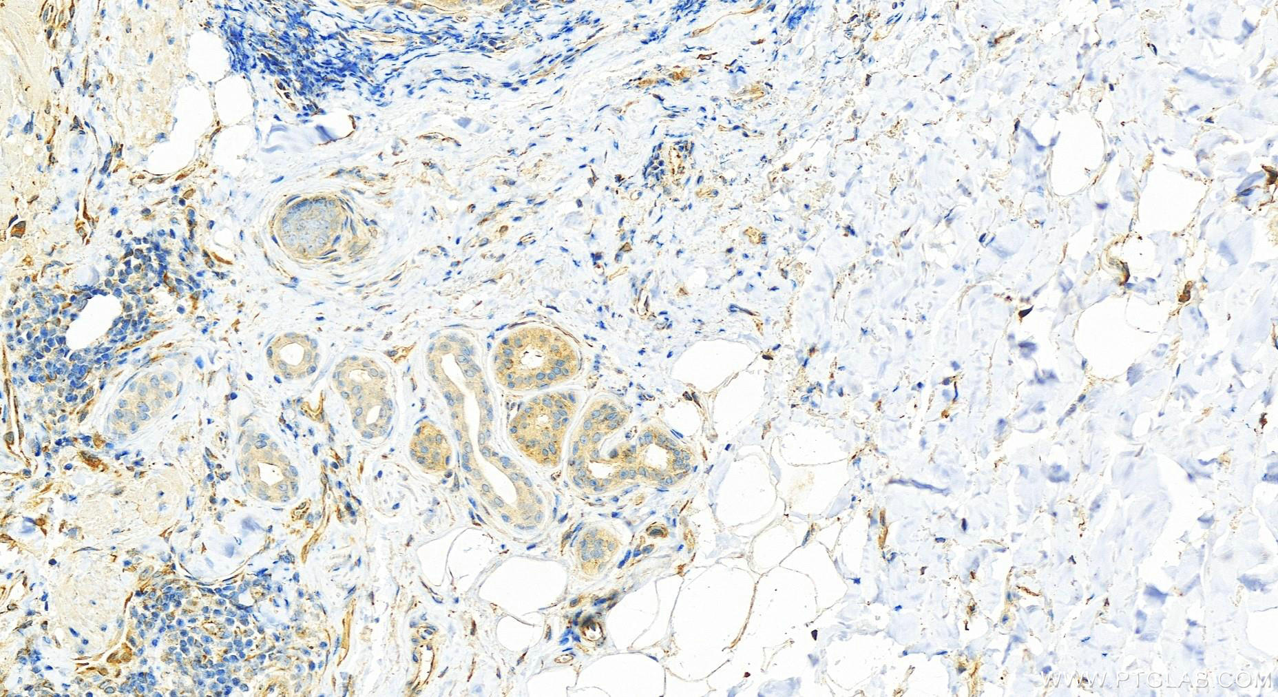 IHC staining of human skin cancer using 14025-1-AP