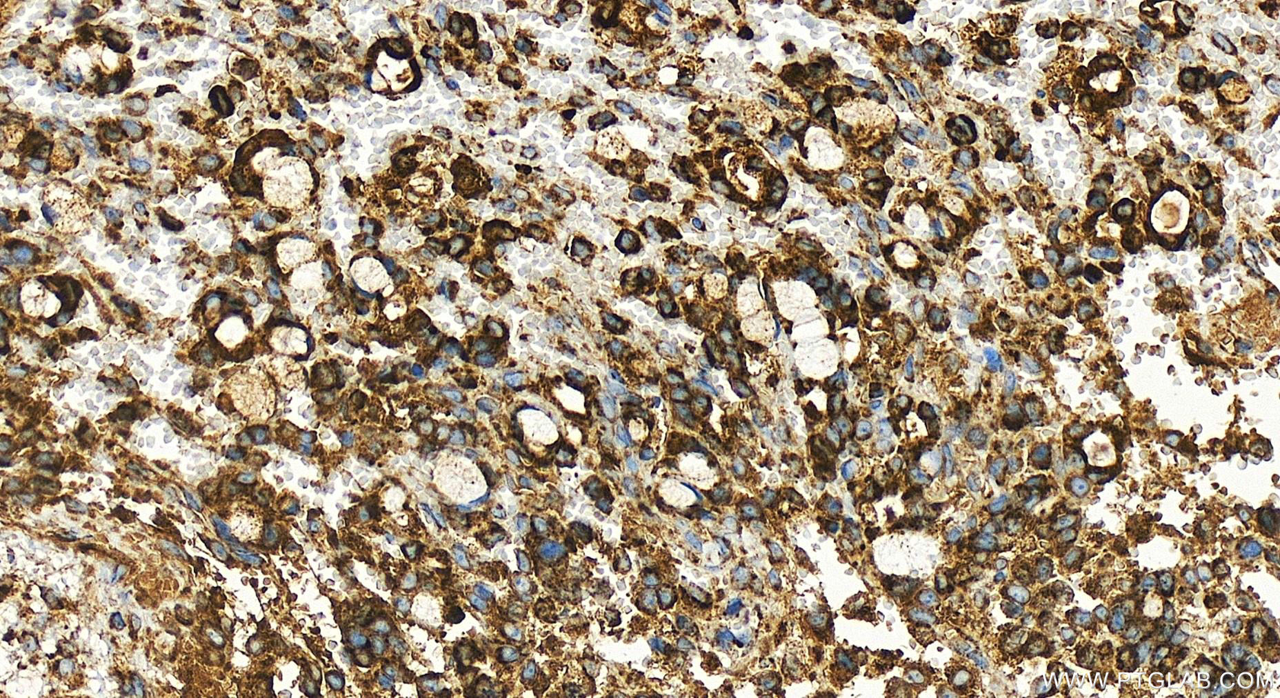 IHC staining of human ovary cancer using 83519-3-RR (same clone as 83519-3-PBS)