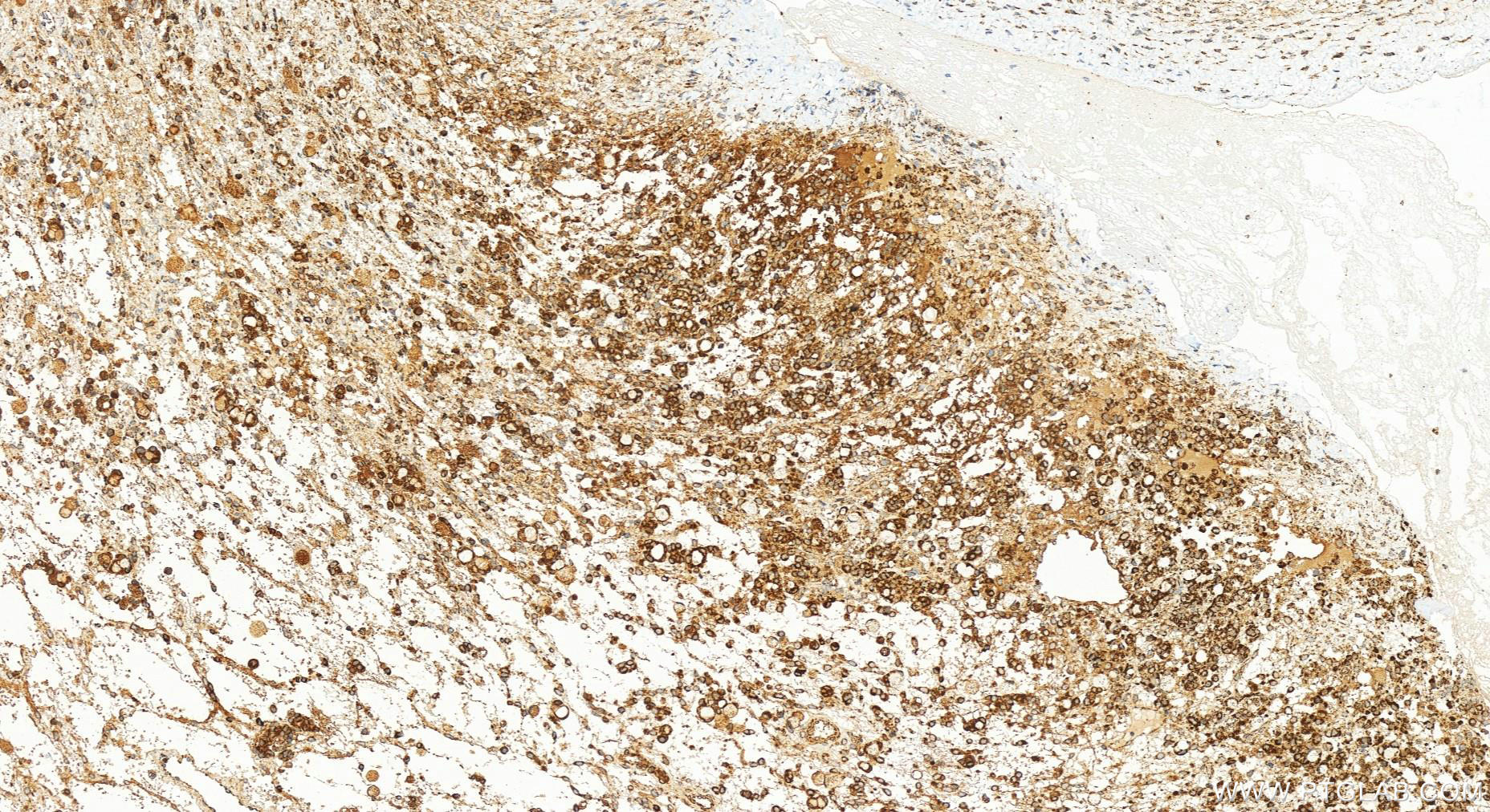 IHC staining of human ovary cancer using 83519-4-RR