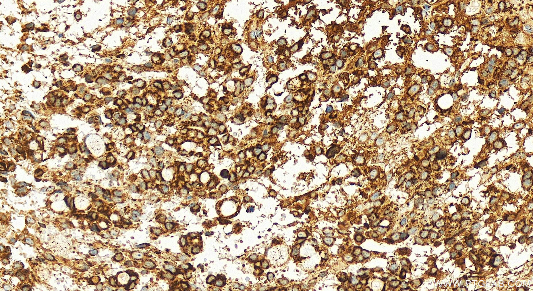 IHC staining of human ovary cancer using 83519-4-RR