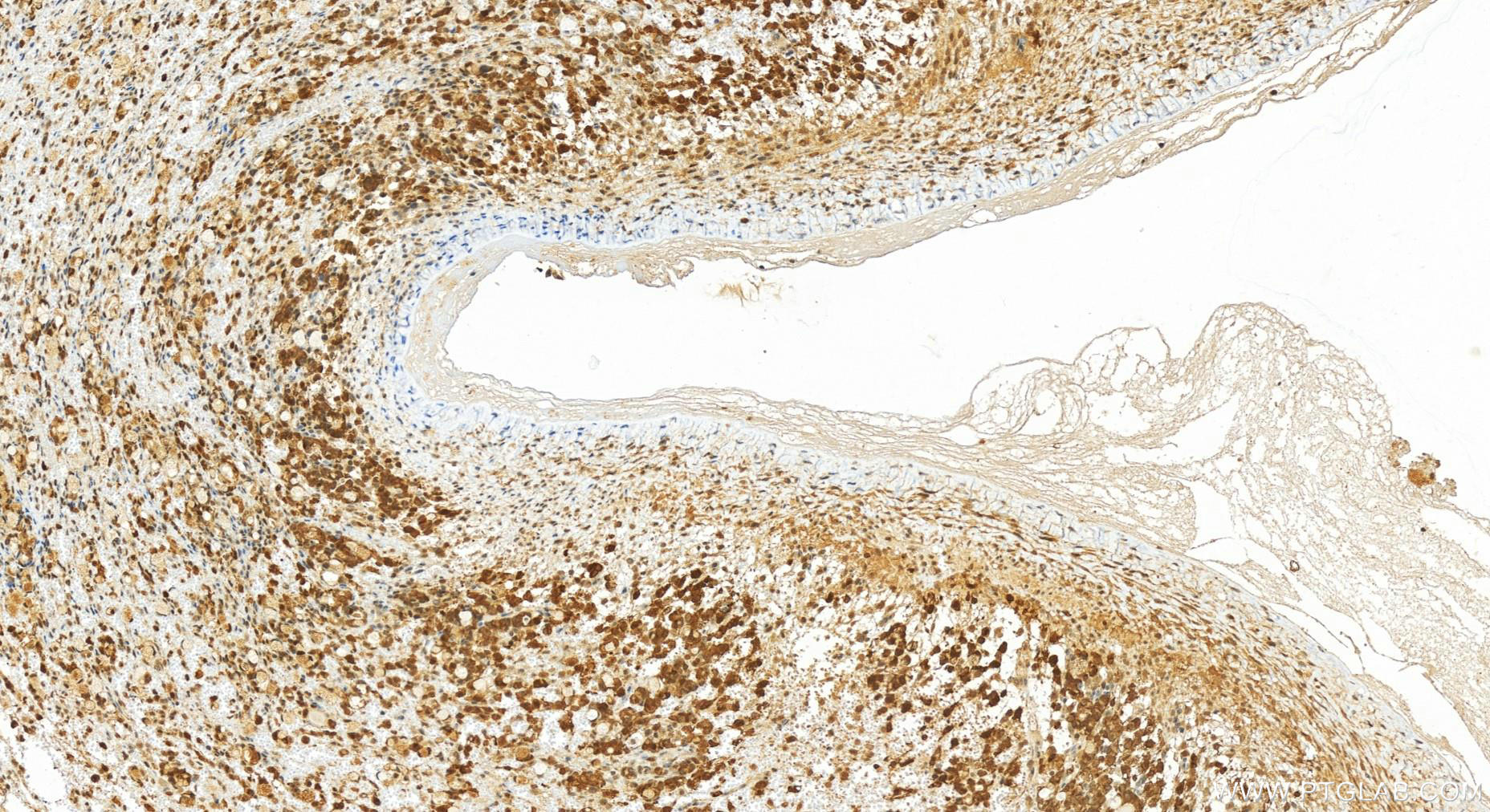 IHC staining of human ovary cancer using 15881-1-AP