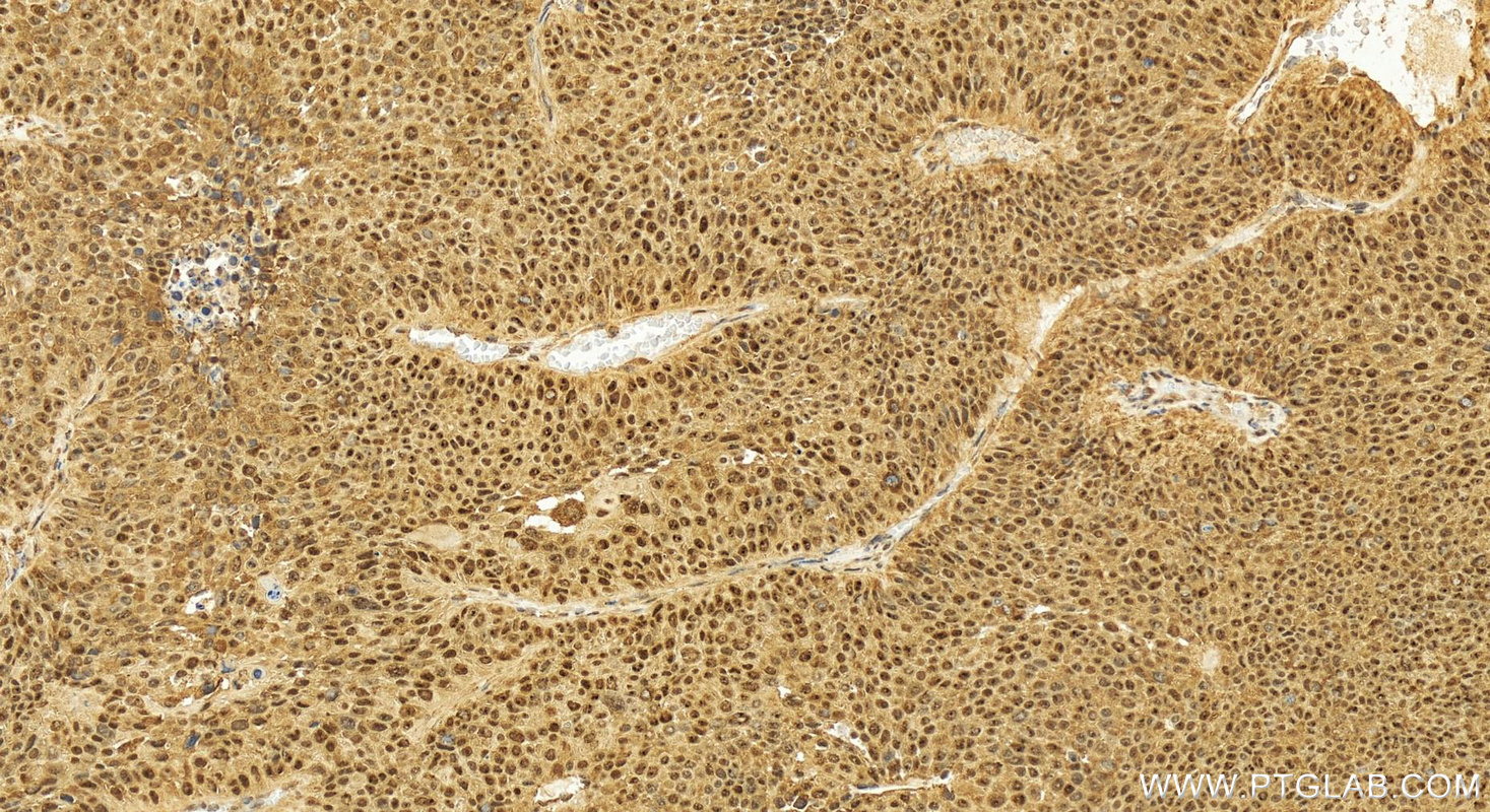 IHC staining of human lung squamous cell carcinoma using 20118-1-AP