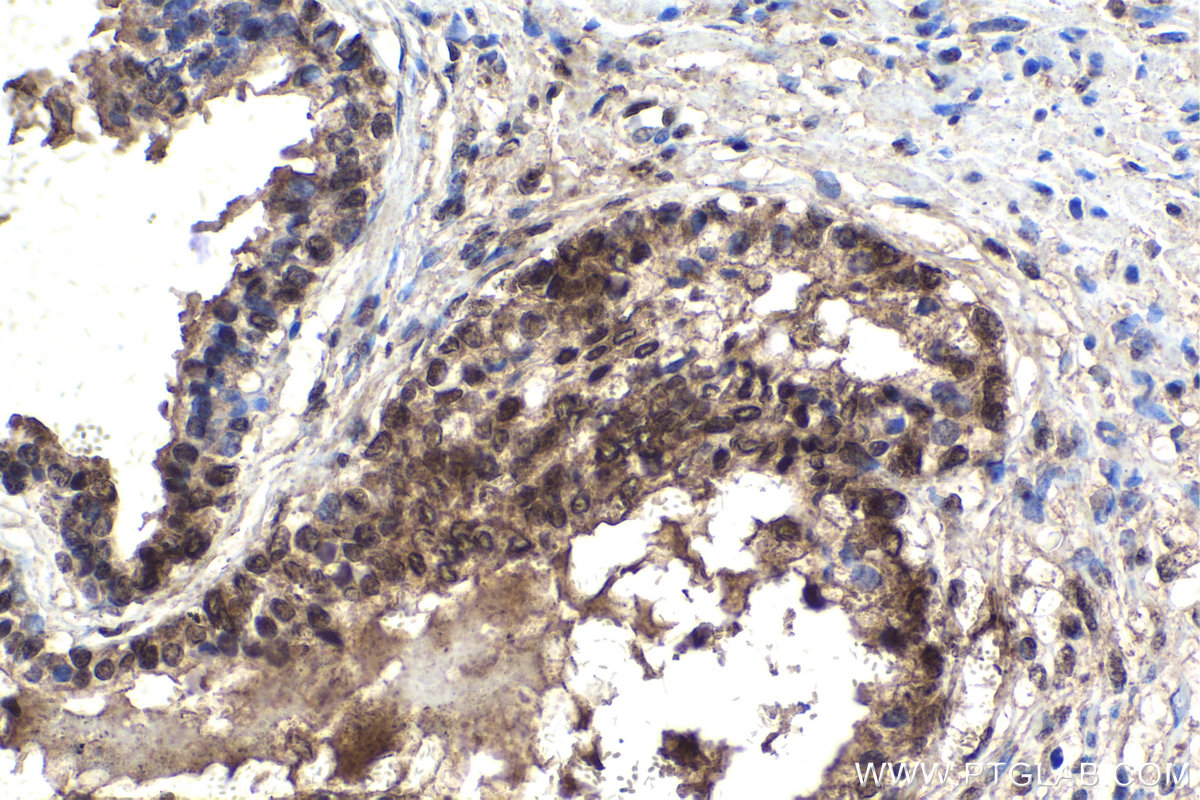 IHC staining of human prostate cancer using 23925-1-AP