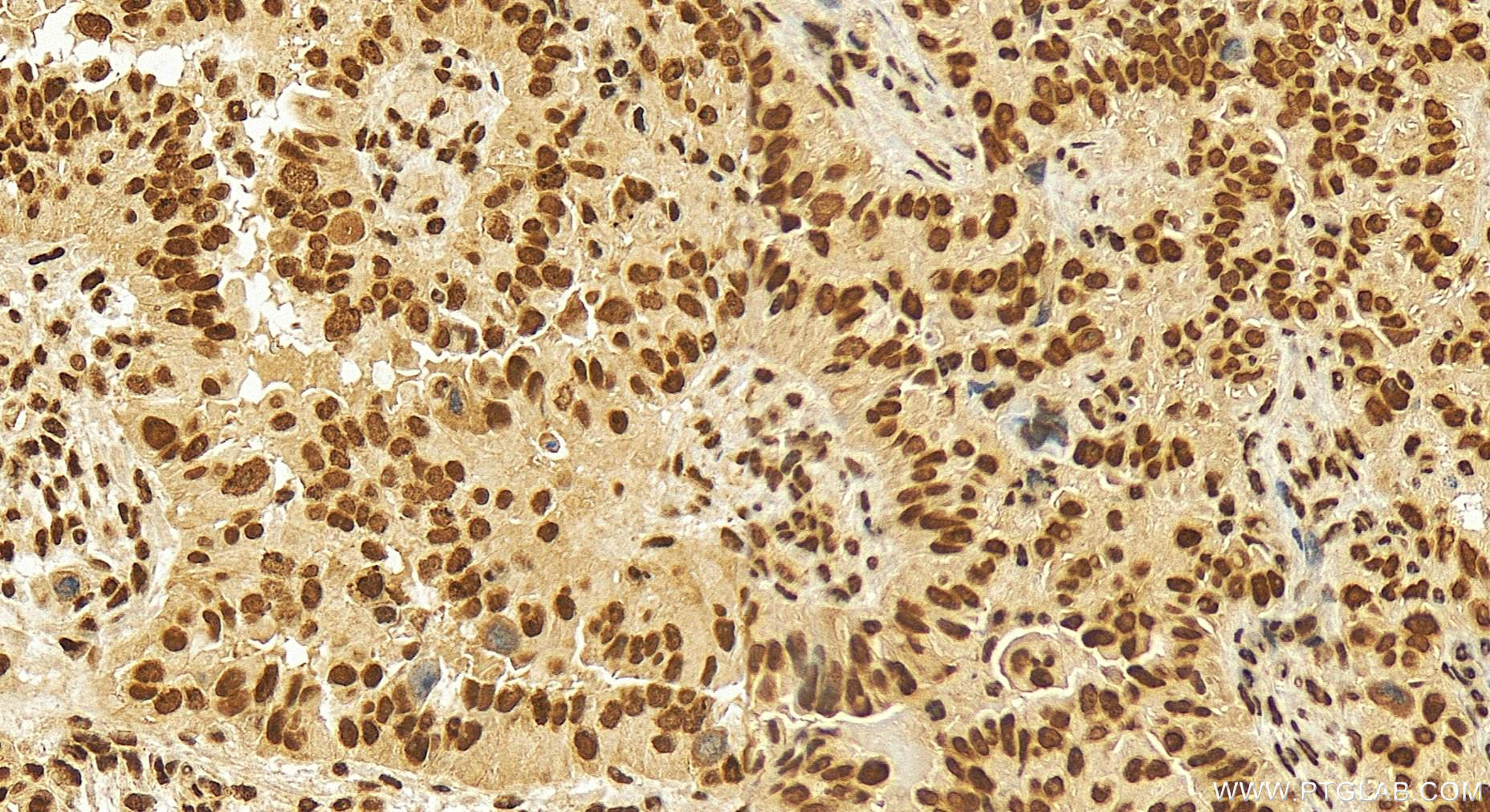 IHC staining of human ovary cancer using 26584-1-AP