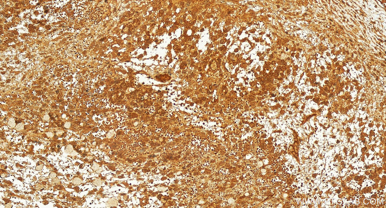 IHC staining of human ovary cancer using 22792-1-AP