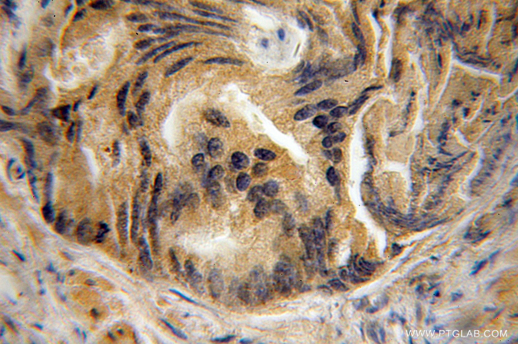 IHC staining of human prostate cancer using 11000-1-AP