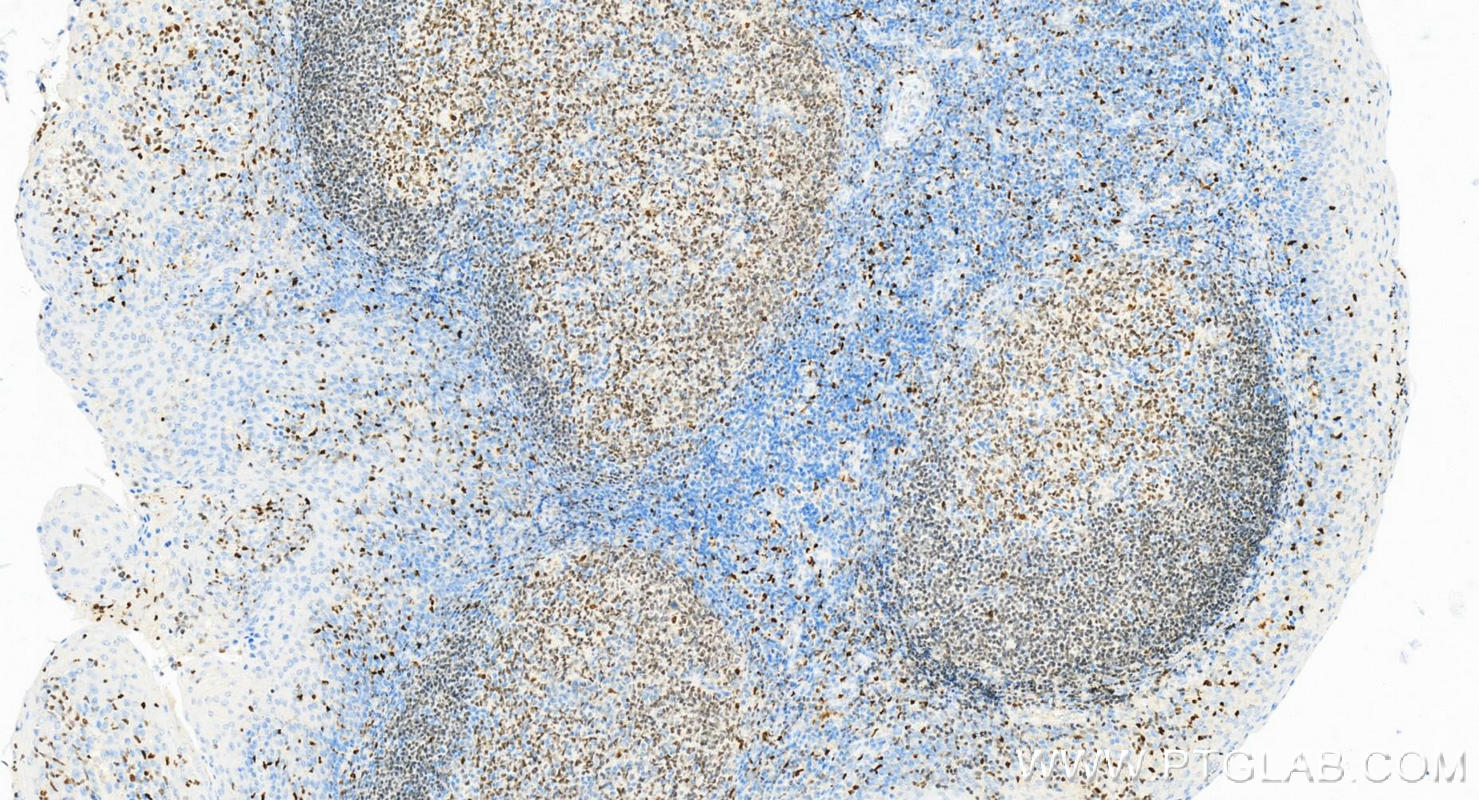 IHC staining of Human tonsillitis using 66618-2-Ig