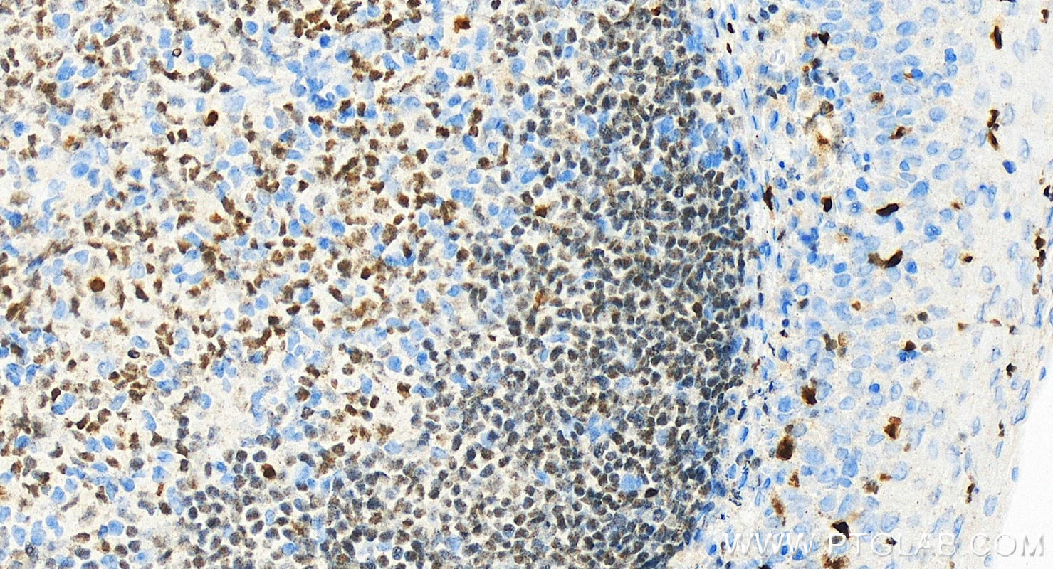 IHC staining of Human tonsillitis using 66618-2-Ig