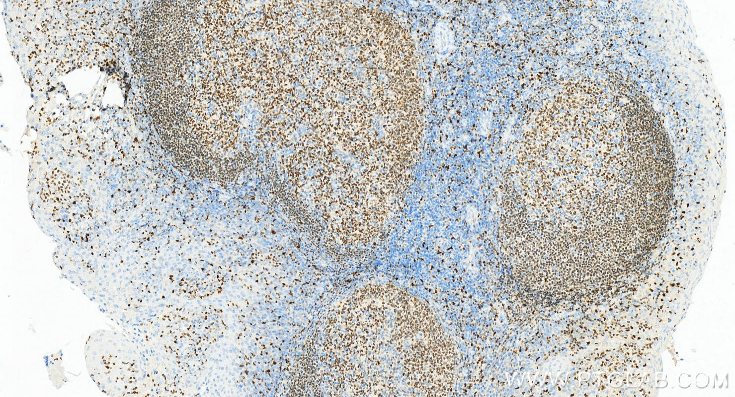 IHC staining of Human tonsillitis using 66618-2-Ig