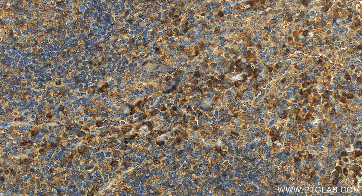 IHC staining of human tonsillitis using 13959-1-AP