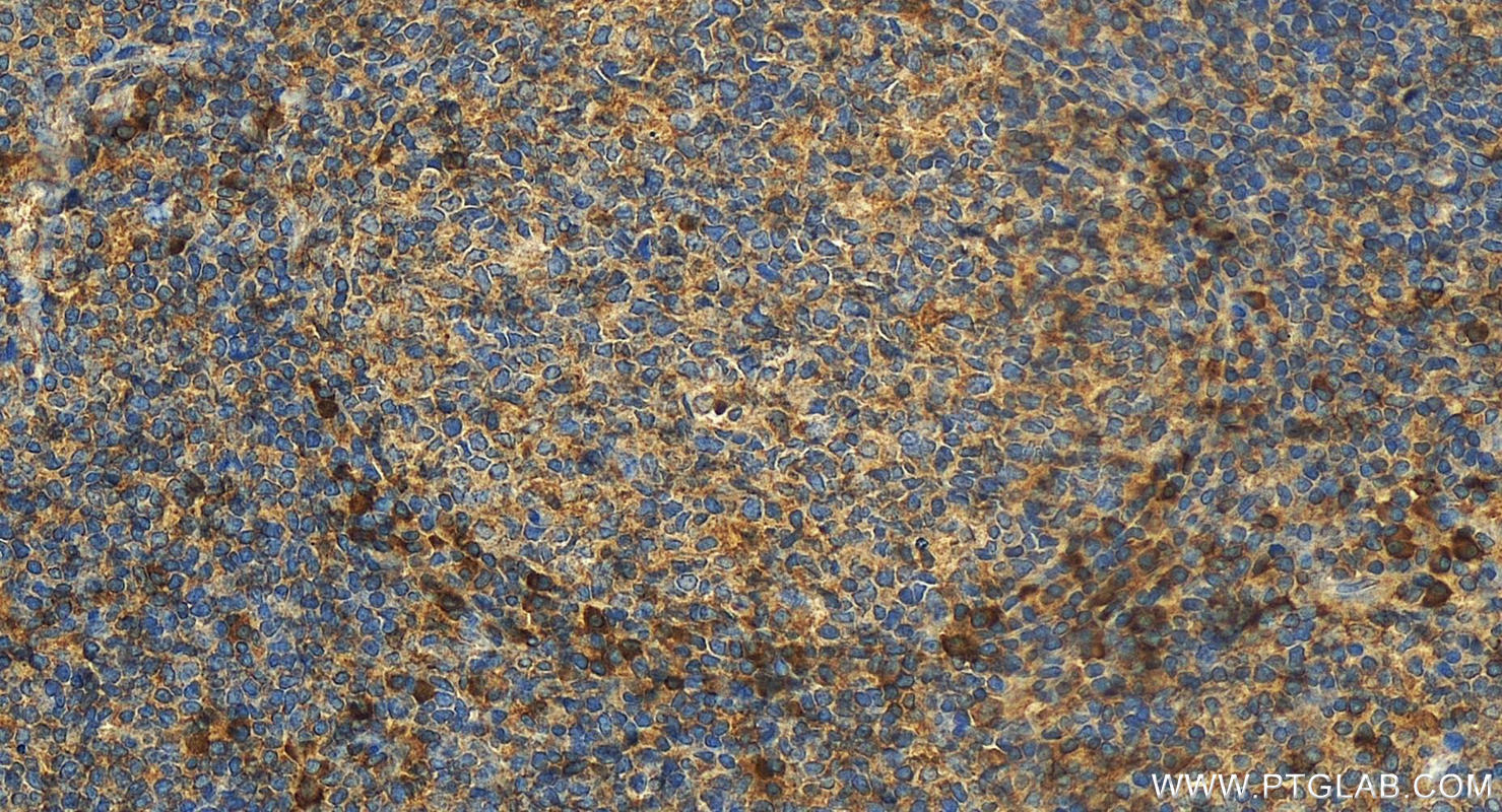 IHC staining of human tonsillitis using 13959-1-AP