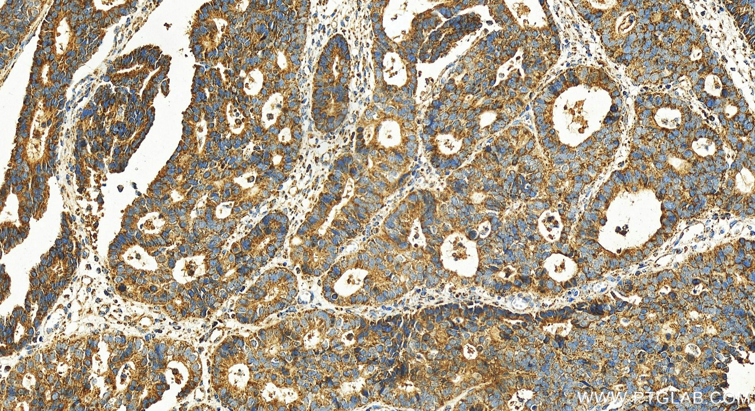 IHC staining of human stomach cancer using 55107-1-AP