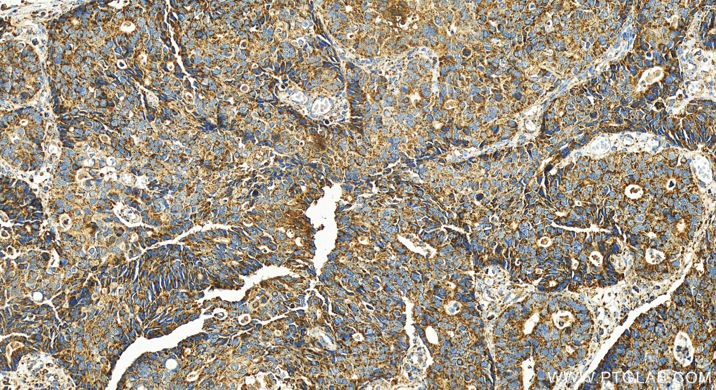 IHC staining of human stomach cancer using 55107-1-AP