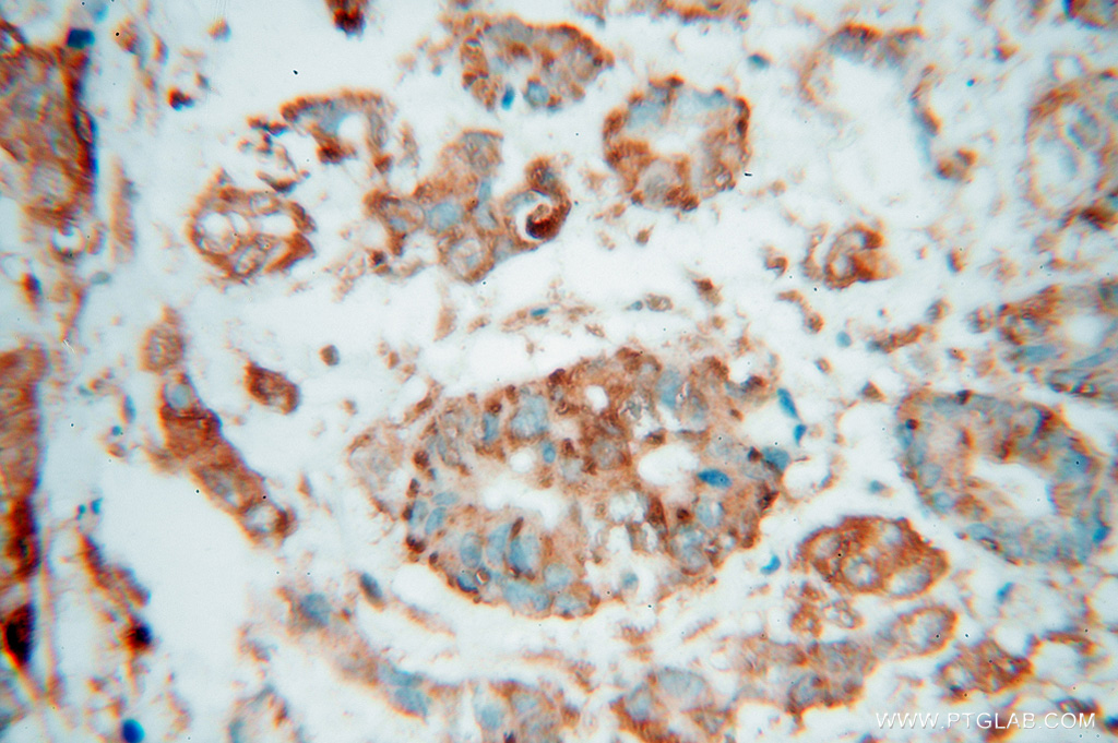 IHC staining of human colon cancer using 15376-1-AP