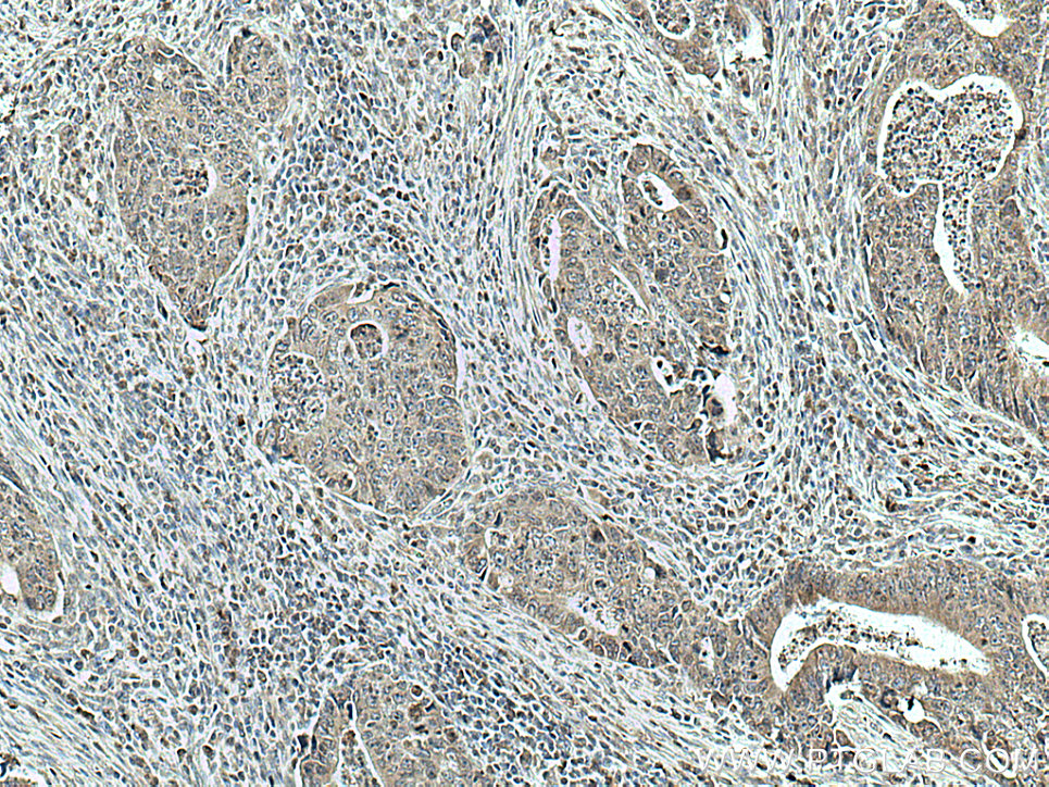 IHC staining of human colon cancer using 66899-1-Ig (same clone as 66899-1-PBS)