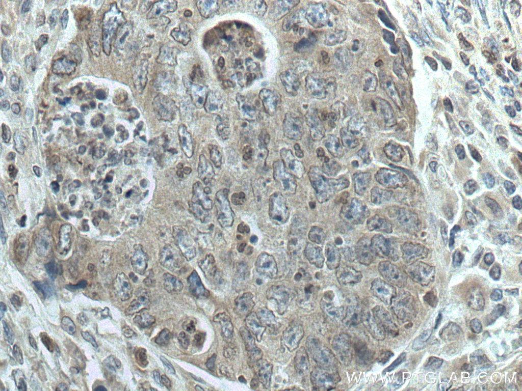 IHC staining of human colon cancer using 66899-1-Ig (same clone as 66899-1-PBS)