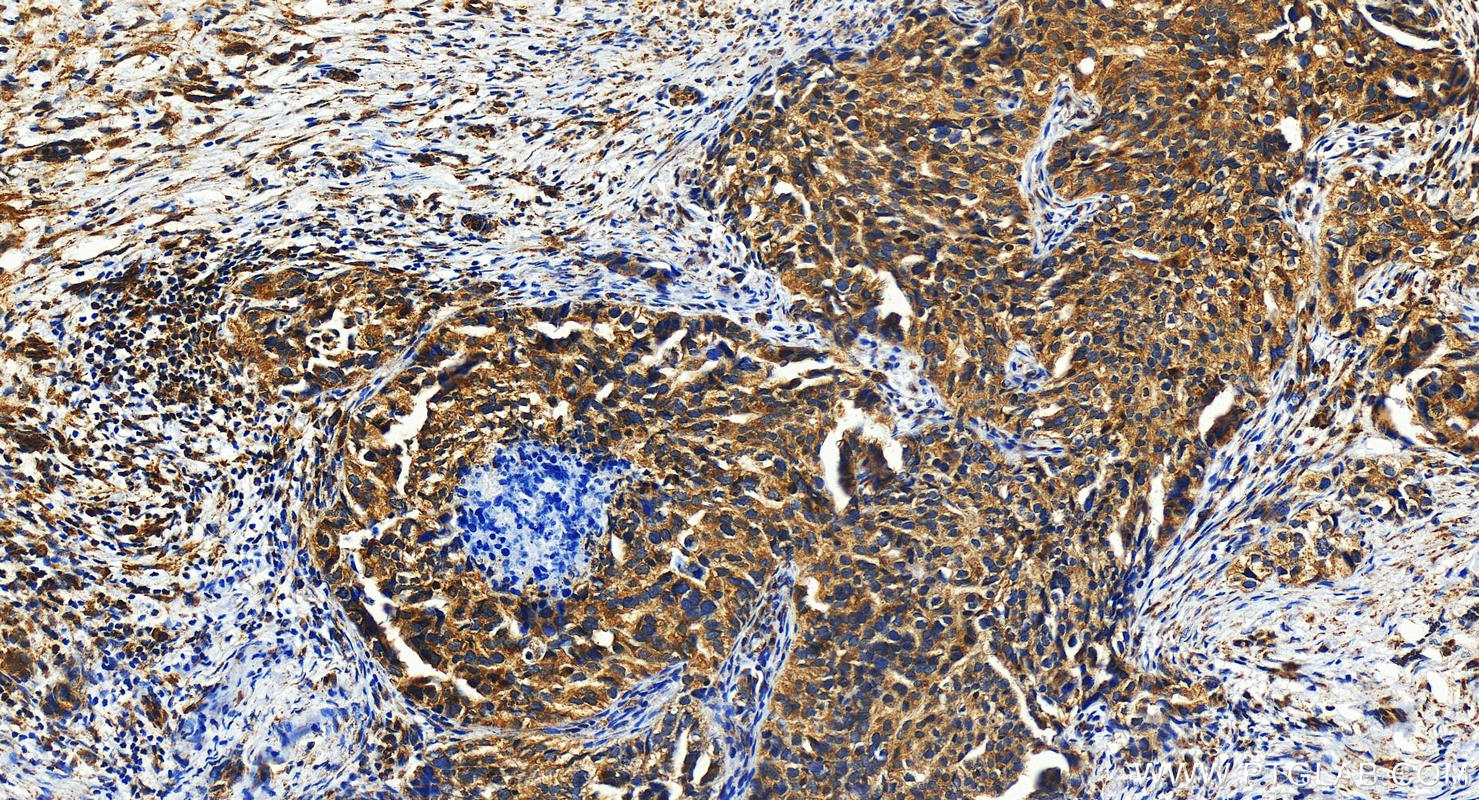 IHC staining of human ovary cancer using 16600-1-AP