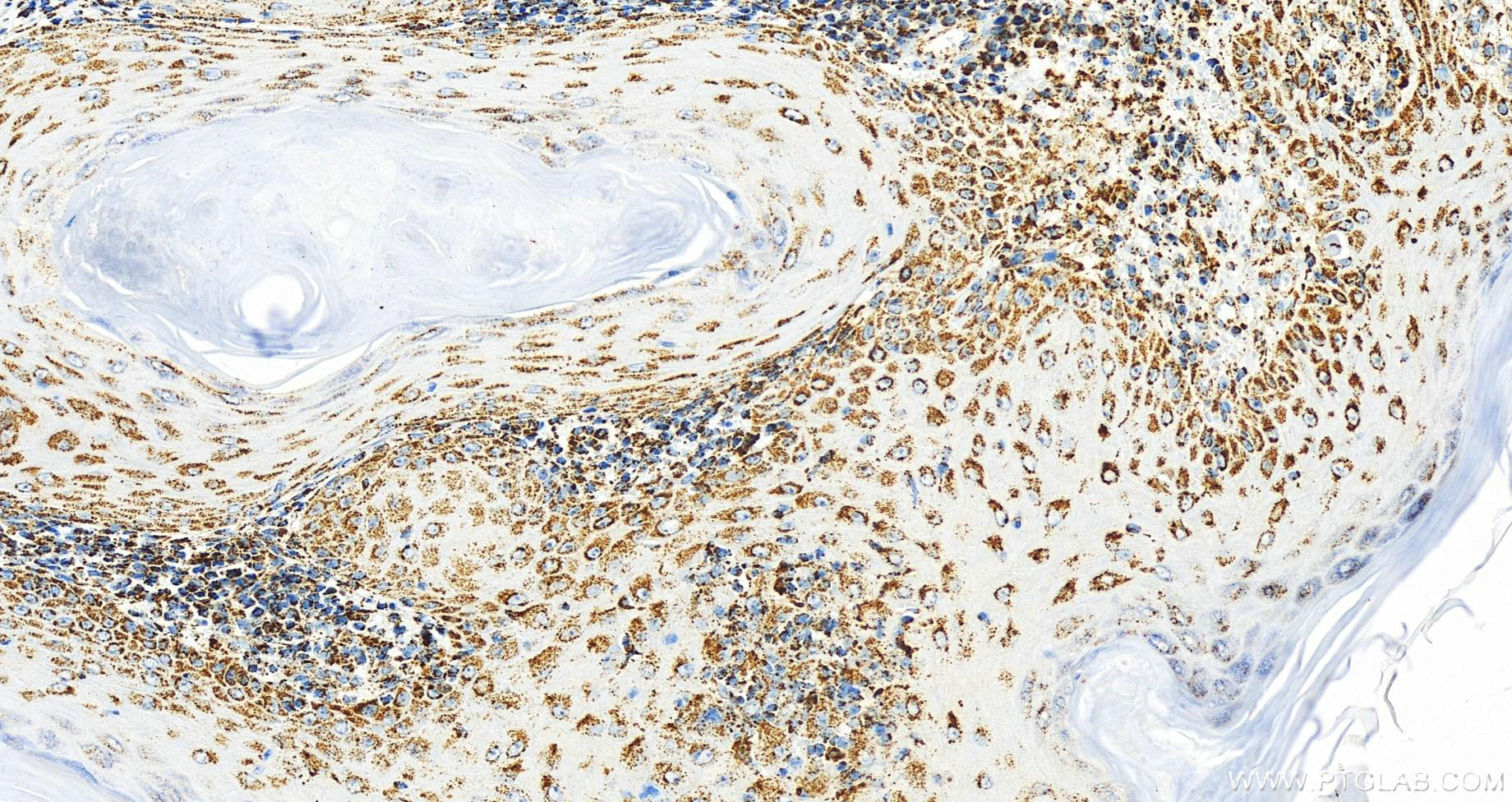 IHC staining of human skin cancer using 68459-1-Ig