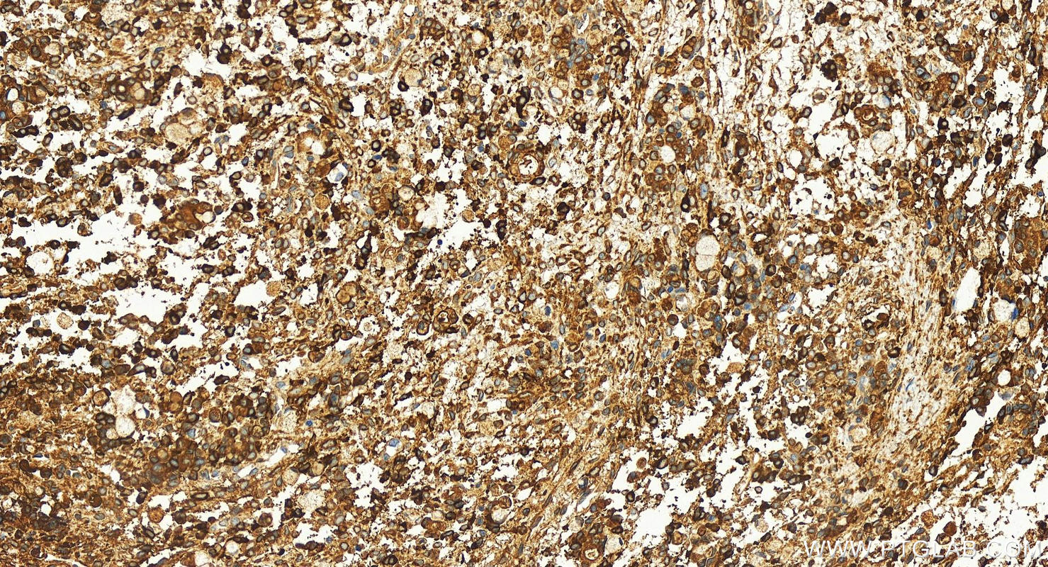 IHC staining of human ovary cancer using 13128-1-AP