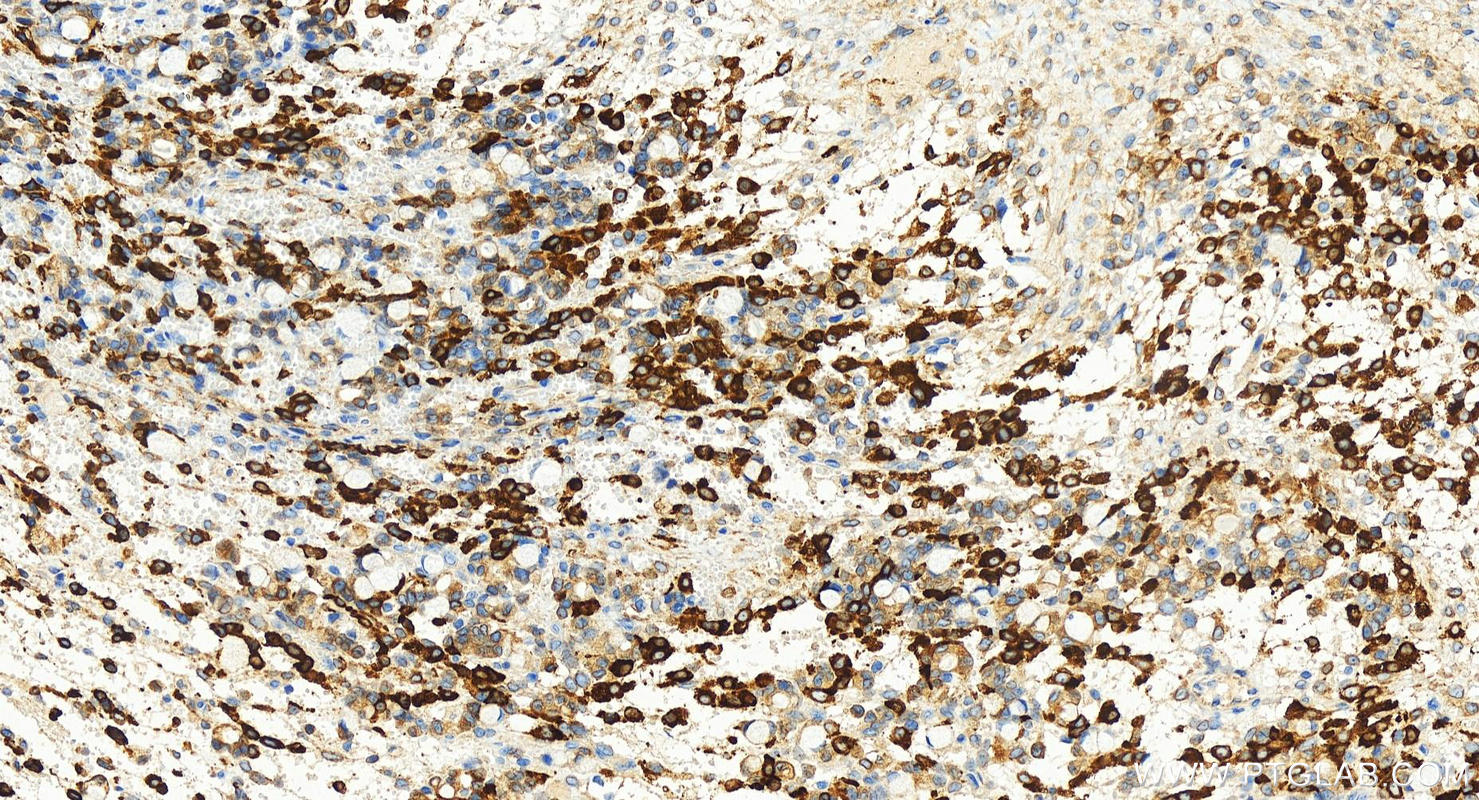 IHC staining of human ovary cancer using 83020-1-RR