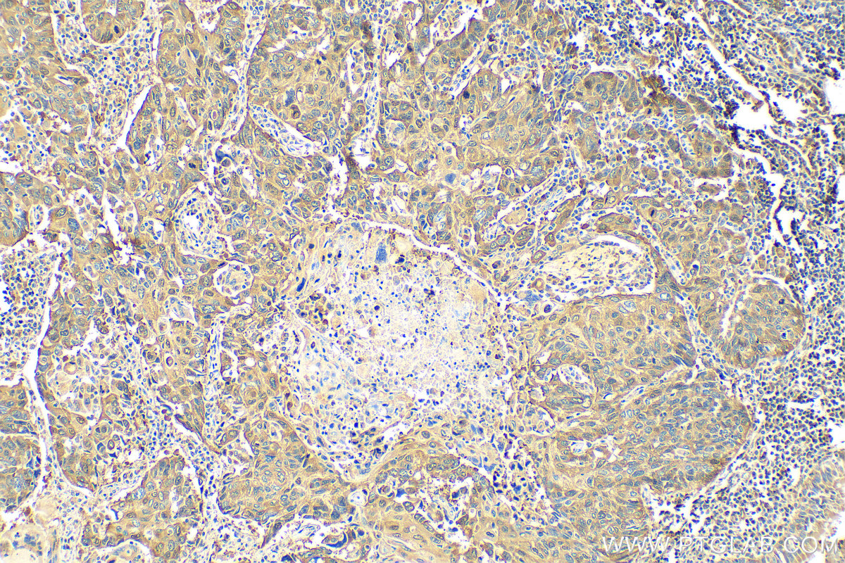 IHC staining of human lung cancer using 18420-1-AP