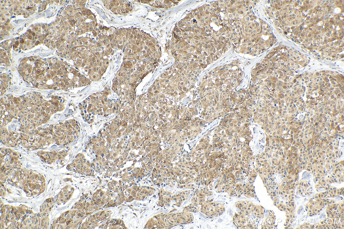 IHC staining of human lung cancer using 18420-1-AP