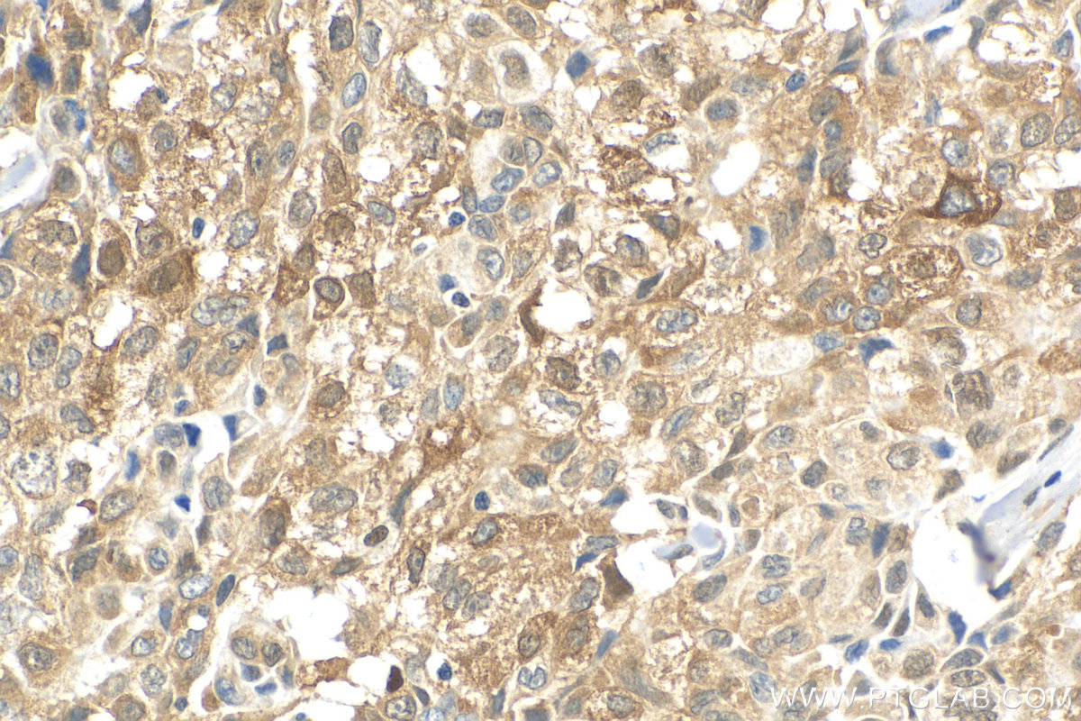 IHC staining of human lung cancer using 18420-1-AP